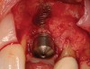 Figure 2  (Case 1) Condition of implant at surgical exposure.