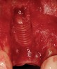 Figure 4  (Case 1) Implant removed and lingual bone maintained to receive augmentation.