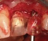 Figure 7  (Case 1) Immediate placement of No. 11. Note stent design to allow for lingual set screw access.