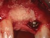 Figure 8  (Case 1) Additional augmentation with demineralized freeze-dried bone allograft at the time of implant placement.