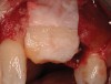 Figure 9: (Case 1) Resorbable membrane for graft containment and autogenous connective tissue graft.