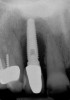 Figure 12  (Case 2) Initial radiograph of compromised implant No. 7.