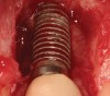 Figure 14  (Case 2) Failed implant at surgical exposure.