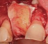 Figure 17  (Case 2) Long-term resorbable membrane in place with autogenous connective tissue.