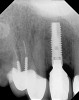 Figure 23  (Case 2) Radiograph at 24 months post loading.