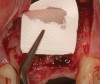 Figure 27  (Case 3) Long-term resorbable membrane.