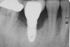 Figure 4  A pre-surgical periapical radiograph of the mandibular right peri-implantitis-affected first molar implant. (Photo reproduced with permission from the American Academy of Periodontology.) (Reference: Froum SJ. Regenerative treatment for peri-implantitis affected implant: a case report. Clinical Advances in Periodontics. 2012. Figure 5  [accepted for publication])