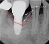 Figure 5  A 7-year post-surgical periapical radiograph showing the bone fill of the defect. (Photo reproduced with permission from the American Academy of Periodontology.) (Reference: Froum SJ. Regenerative treatment for peri-implantitis affected implant: a case report. Clinical Advances in Periodontics. 2012. Figure 13. [accepted for publication])