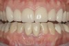 Figure 1  Initial presentation with yellow, poorly color-matched restored mandibular anterior teeth.