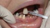 Figure 3  Shade selection for final crowns, teeth Nos. 22 through 28; post-extraction of No. 26 and decoronation of Nos. 24 and 25; Nos. 22, 23, 27, and 28 prepared for full coverage.