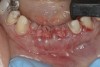 Figure 4  Extraction sites Nos. 24 and 25 after socket augmentation; additional grafting, site No. 26; flaps approximated with 4-0 polyglactin 910 sutures.