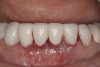Figure 5  Seven-unit bisacryl provisional bridge—Nos. 22 through 28—fabricated by restorative dentist.