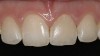 Figure 11  Original feldspathic porcelain crown placed by restorative dentist, tooth No. 9—facial view.