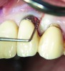 Fig 3. Bleeding on probing and increasing pocket depths around implant sites indicates a need for treatment.
