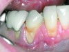 Fig 4. Severe recession visible on teeth Nos. 29 and 30.