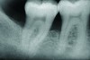 Fig 10. Postoperative x-ray depicts bone fill of the defect 2 years after regenerative therapy.