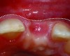 Fig 3. Facial bone resorption resulting in loss of tissue contour is common where ridge preservation was not incorporated into the extraction procedure.