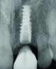 Fig 13. Implant placement in the site No. 9. Blunted root apices on Nos. 8 and 10 associated with prior orthodontic treatment.