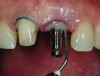 Fig 19. Prepared tooth No. 8 and customization of a stock impression coping for final impression.