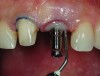 Fig 19. Prepared tooth No. 8 and customization of a stock impression coping for final impression.