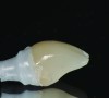 Fig 22. Retained cement on a zirconia abutment, where the cement line was either not ideally positioned relative to the free gingival margin, or where a cementation technique that introduced cement subgingivally was used.