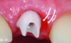 Fig 24. A custom zirconia abutment, which is not ideally designed and does not follow the interproximal rise of the gingival tissue as developed with a provisional restoration.