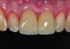 Fig 29. One-year radiograph of the definitive restorations on the implants Nos. 8 and 9. Note the crestal bone stability compared to the radiograph taken on the day of surgery in Figure 28.