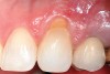 Fig 1 and Fig 2. Non-carious cervical lesion on the root surface of a maxillary canine. There was no attached gingiva, the cervical lesion was less than 2 mm in depth, and the recession was Miller Class I.