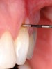 Fig 1 and Fig 2. Non-carious cervical lesion on the root surface of a maxillary canine. There was no attached gingiva, the cervical lesion was less than 2 mm in depth, and the recession was Miller Class I.