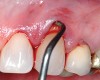 Fig 3 and Fig 4. After mobilization of the marginal tissue, the sharp margins of the lesion were flattened and the enamel overhang was beveled.