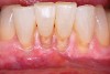 Fig 8 and Fig 9. Non-carious cervical lesions of moderate depth, Miller Class III gingival recession, absence of attached gingiva, shallow vestibule, and extrusion of the central incisors.