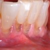 Fig 8 and Fig 9. Non-carious cervical lesions of moderate depth, Miller Class III gingival recession, absence of attached gingiva, shallow vestibule, and extrusion of the central incisors.