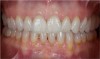 Figure 6 The final restoration met the patient’s treatment goals, with closure of the diastema and symmetry between the dental and facial esthetics.