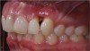 Figure 9 The high smile with the significant loss of papilla and “black triangle” presented a clinical dental and a psychological problem for the patient.