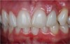 Figure 10 The prosthetic treatment of a single-unit porcelain-fused-to-metal crown with gingival ceramics created the illusion of elimination of the defect and was an excellent solution for this patient.