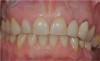 Figure 20 Intraoral examination revealed multiple concerns, including loss of vertical dimension, lack of posterior tooth support, and supra-eruption. There was also gingival asymmetry, and minimal zones of attached gingiva.