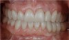 Figure 27 The healthy periodontal and dental implant foundation and gingival symmetry set the framework for the completion of the lithium-disilicate all-ceramic restorations.
