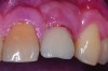 Clinical view of maxillary left lateral incisor implant in a healthy 48-year-old man. The swelling in the tissue surrounding this implant also bled on probing with depths up to 8 mm and exhibited purulence. The implant has been present for 14 years.