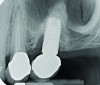 Radiograph of the area suggests moderate to advanced bone loss at the mesial aspect making the diagnosis peri-implantitis.