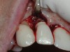 Fig 1. This implant was placed in March 2006. Peri-implantitis was clinically evident in April 2008, with bleeding on probing, suppuration, and increasing probing depth.
