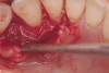 An amnion-chorion membrane adapted over the bone graft.