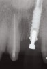 Fig 2. After implant placement, the radiograph suggests that without the planned surgical crown lengthening on the adjacent teeth, the implant crown would emerge substantially more apically than the adjacent natural teeth.