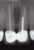 Fig 1. Preoperative radiograph of a case begins a discussion with the patient as to potential treatments, including implant placement, crowns, and crown lengthening, for a better prosthetic result.