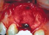 Fig 5. Surgical placement of the implant with bone grafting as necessary.