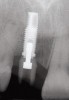 Fig 8. The abutment seated on the implant.