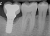 Pretreatment radiograph of a peri-implantitis
lesion on a 51-year-old male patient with a noncontributory medical history. The implant had been placed 3 years prior and presented with 8 mm pocketing with purulence.