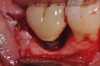 Clinical exposure of a circumferential lesion that demonstrates 3 mm of bone loss. No cement was present, suggesting that the lesion was of bacterial origin. Surface decontamination included citric acid.