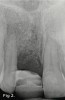 Fig 2. Radiograph showing the loss of periodontal attachment on the mesial aspect of tooth No. 7. A bone graft was placed when the implant was removed.
