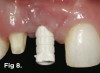 Fig 8. Following stage 2 implant uncovering and allowing the mucosal tissue to mature, a screw-retained temporary implant cylinder was seated to allow connection of an acrylic tooth.