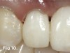 Fig 10. After a few weeks of healing of the soft tissues after non-surgical tissue sculpting, a gingivectomy was done to re-shape the gingival zenith and levels of teeth Nos. 6 through 8.